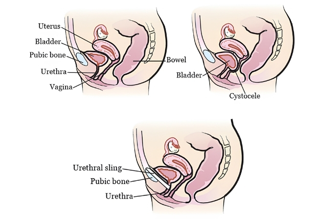 Cystocele